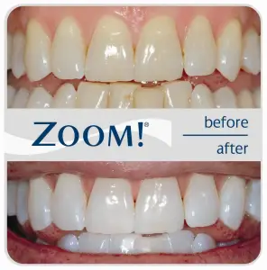 Zoom Teeth Whitening