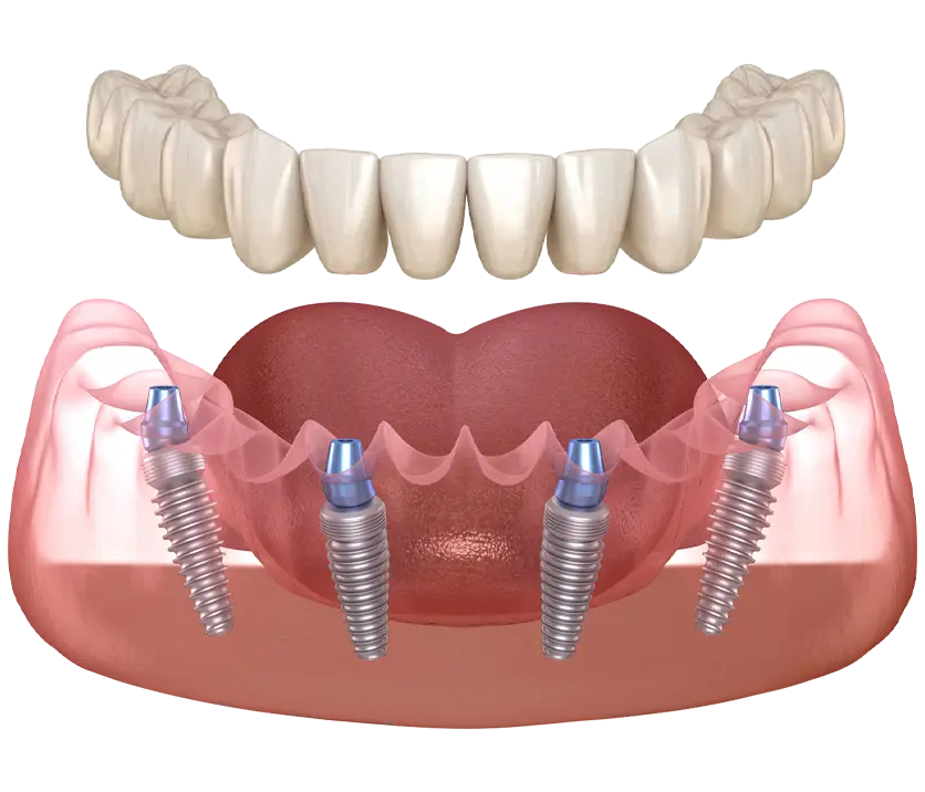 Dental Implants
